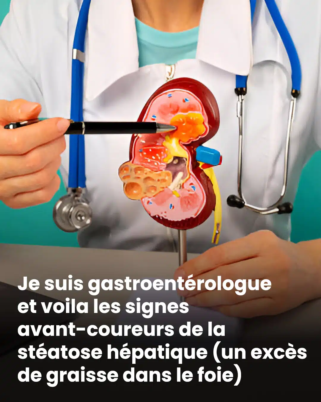Je suis gastroentérologue et je vous explique les premiers signes qui peuvent révéler une stéatose hépatique, c’est-à-dire un excès de graisse dans le foie