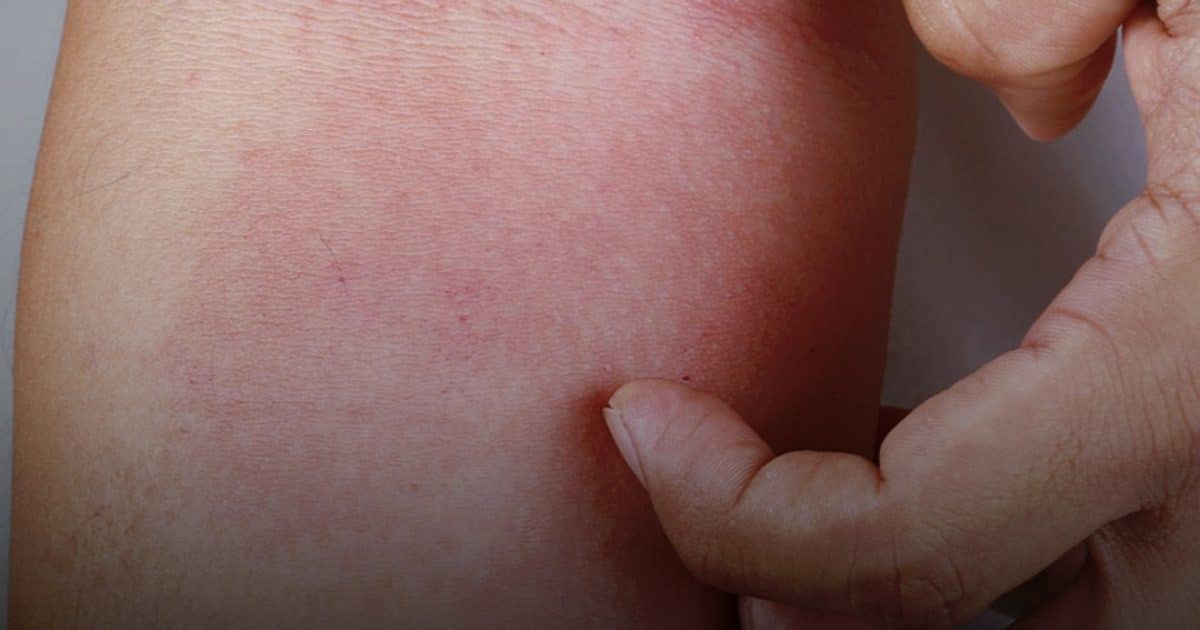 La gale fait son retour en France : voici les 2 signes à surveiller chez votre enfant