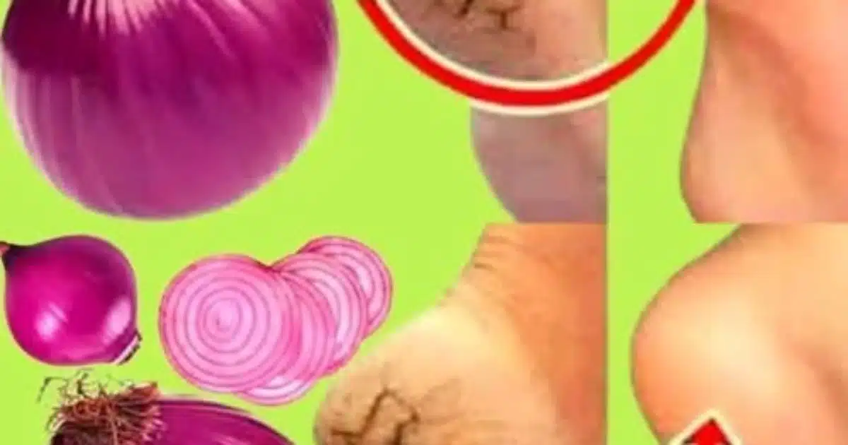 L'astuce de l'oignon pour lutter contre les talons fendillés