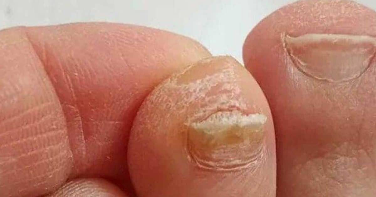 L'astuce pour diminuer l'épaisseur des ongles de pied