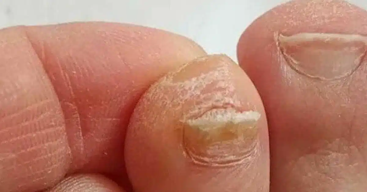 L'astuce pour diminuer l'épaisseur des ongles de pied