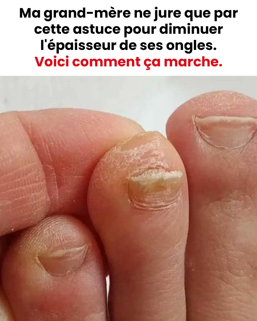 L'astuce pour diminuer l'épaisseur des ongles de pied