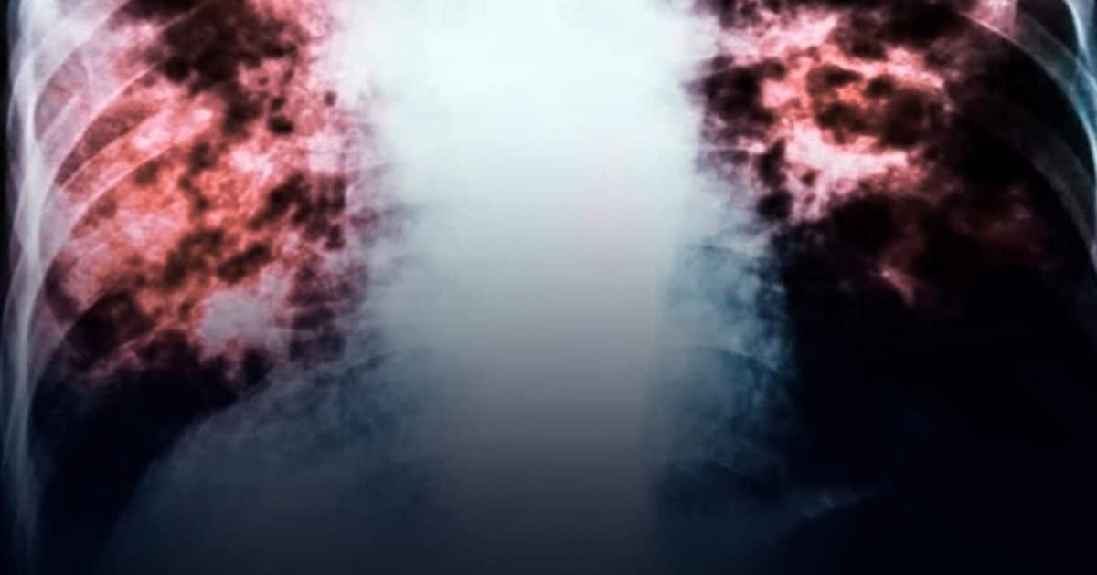 Le cancer du poumon est en augmentation chez les personnes qui n’ont jamais fumé, et cela pourrait en être la raison