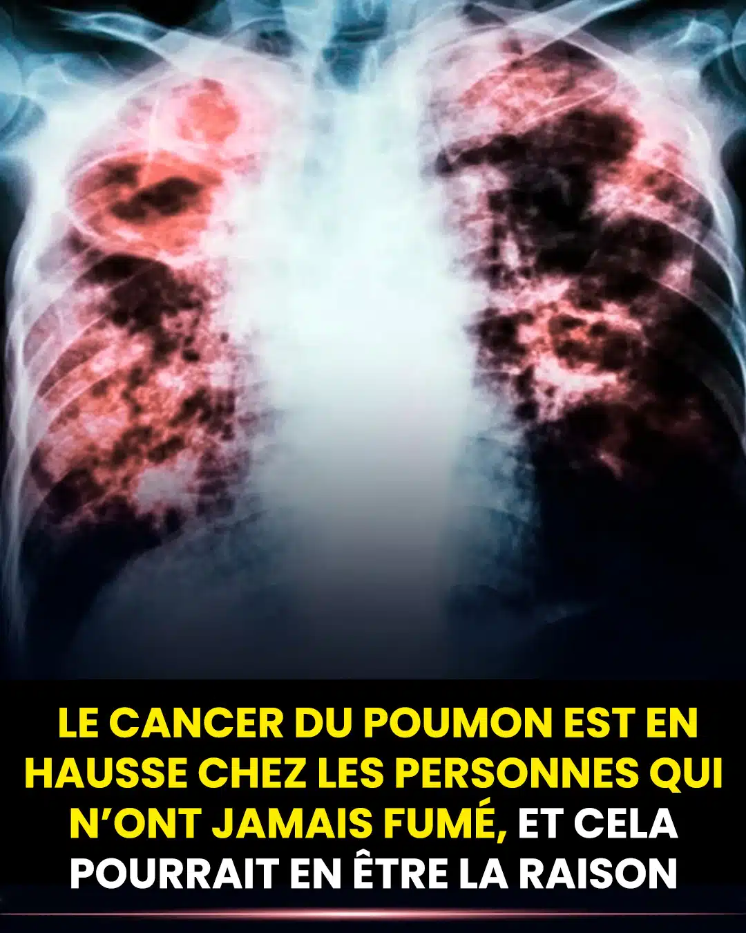 Le cancer du poumon est en augmentation chez les personnes qui n’ont jamais fumé, et cela pourrait en être la raison