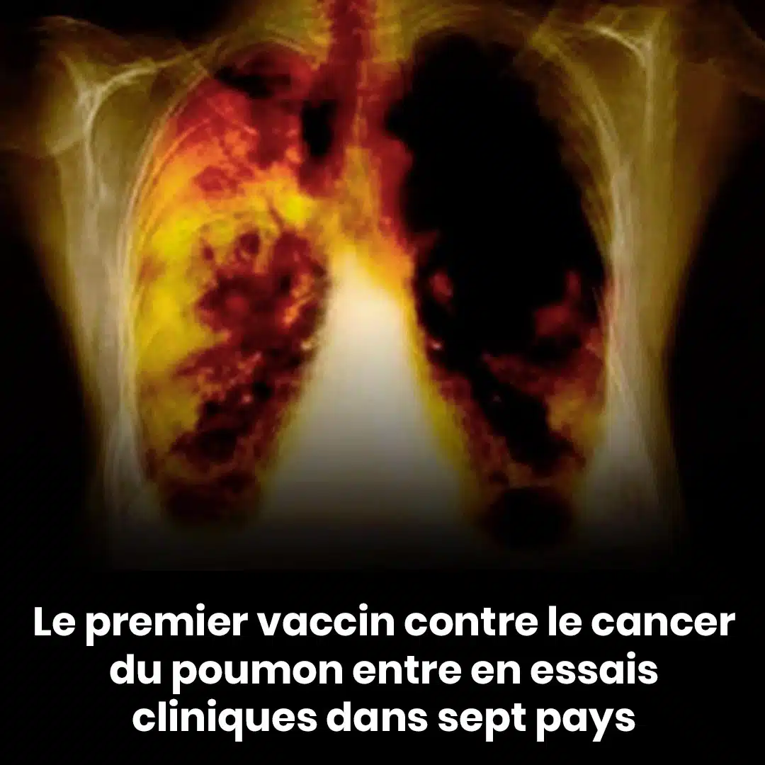 Le premier vaccin contre le cancer du poumon entre dans la phase d’essai clinique dans sept pays