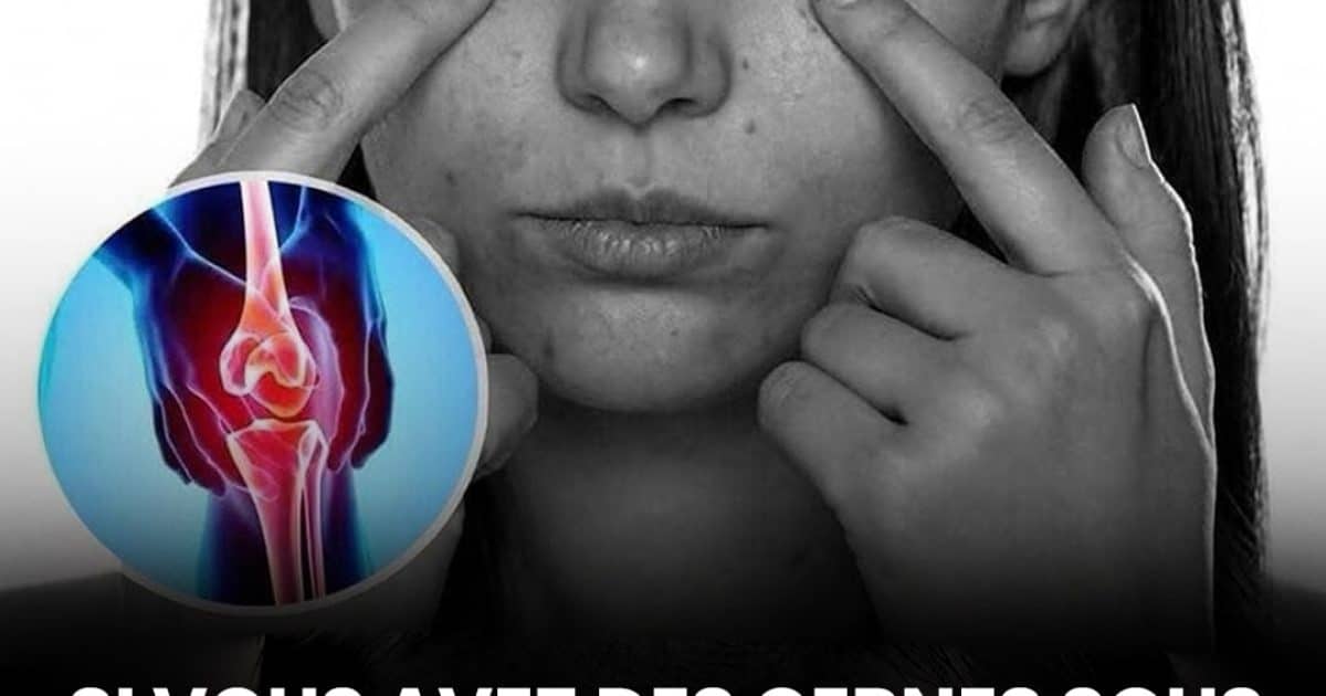 Les cernes sous les yeux pourraient être un signe discret d’un problème de santé