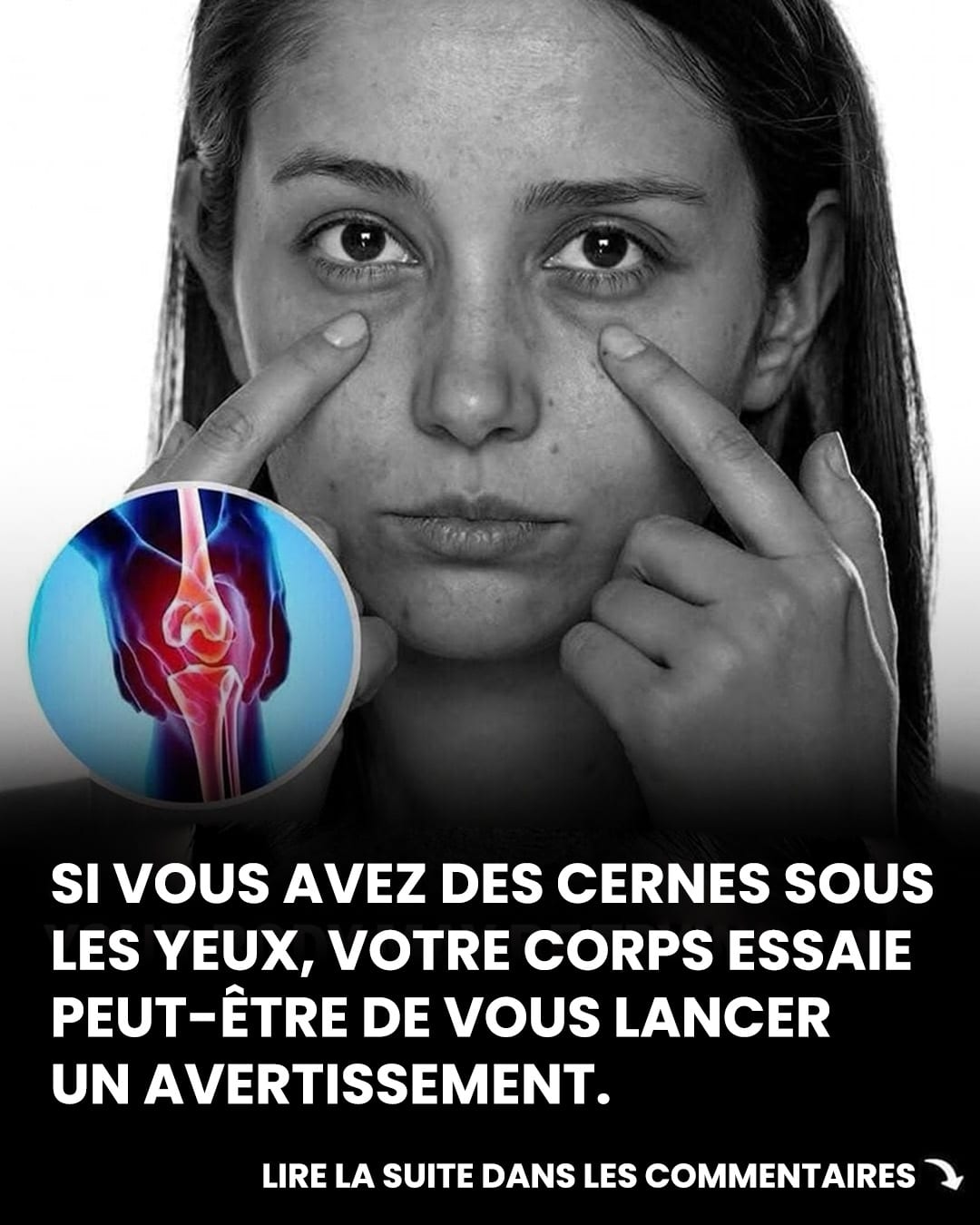Les cernes sous les yeux pourraient être un signe discret d’un problème de santé