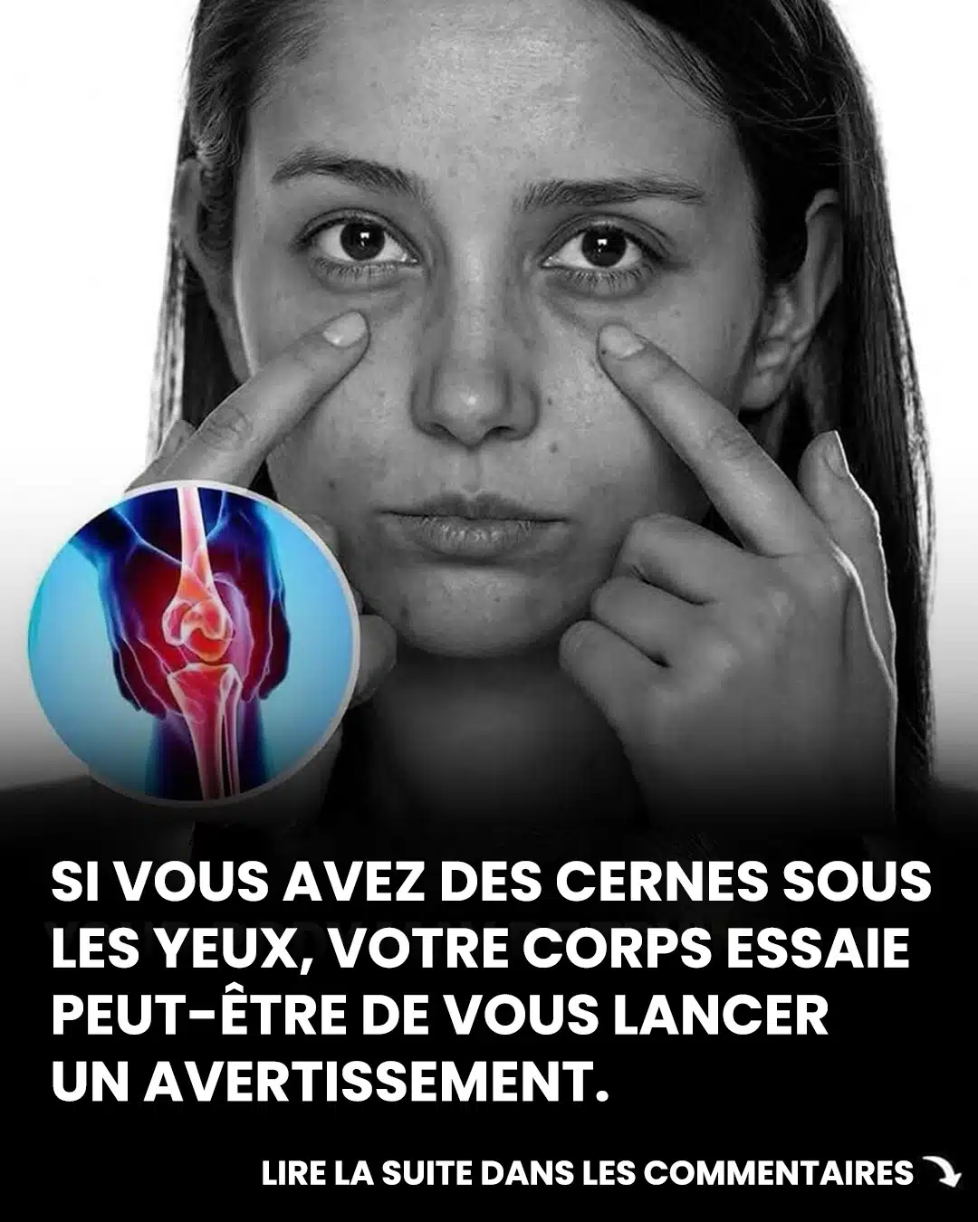 Les cernes sous les yeux pourraient être un signe discret d’un problème de santé