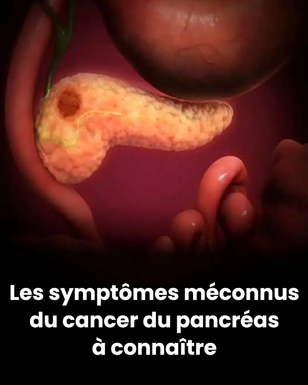 Les symptômes du cancer du pancréas