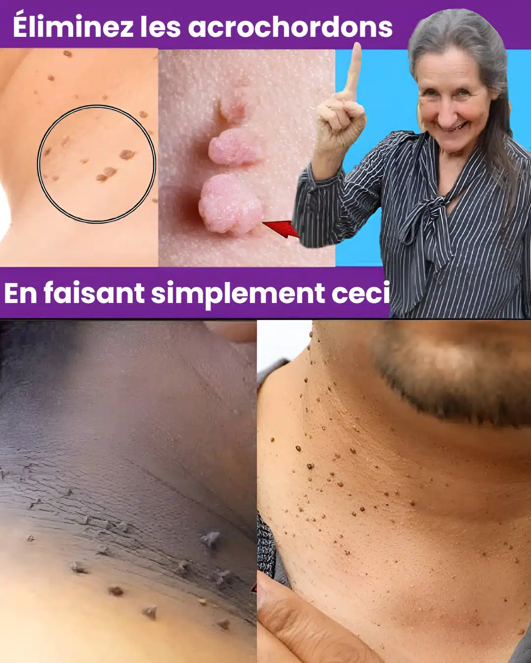 Les verrues plantaires et les acrochordons disparaissent en un jour avec cette recette