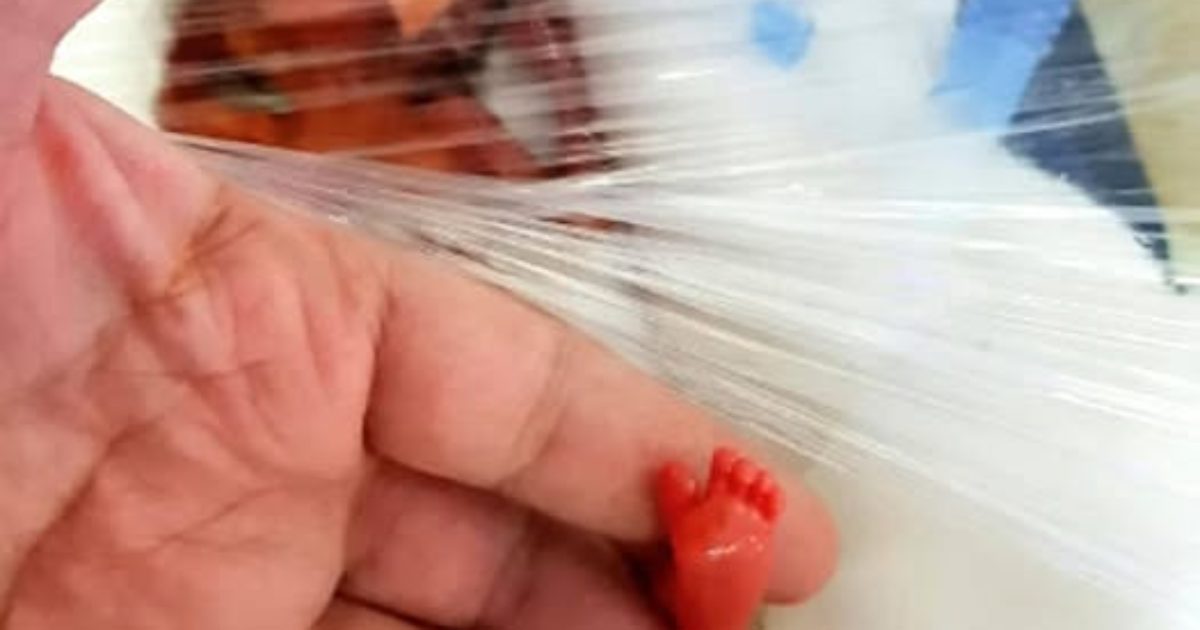 L'histoire incroyable de Tru Beare, née avec un poids d'à peine 500 grammes