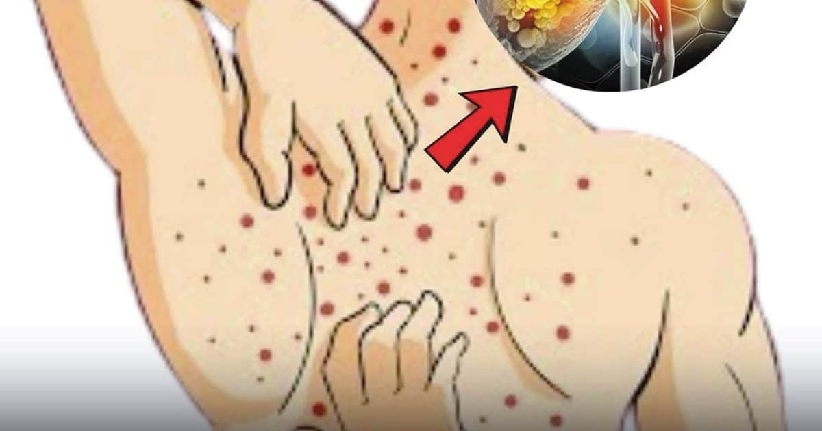 Maladie du foie gras (stéatose hépatique) : causes, symptômes, traitement et remèdes maison