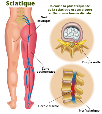 meilleurs traitements naturels contre la sciatique