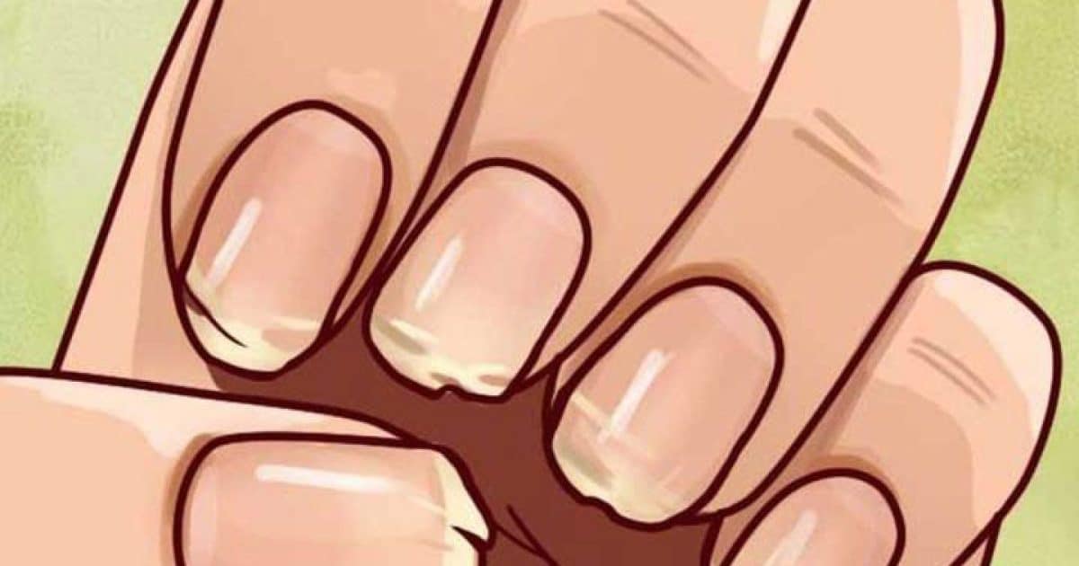 Ongles cassants ou dédoublés ? Ce que votre corps essaie peut-être de vous dire