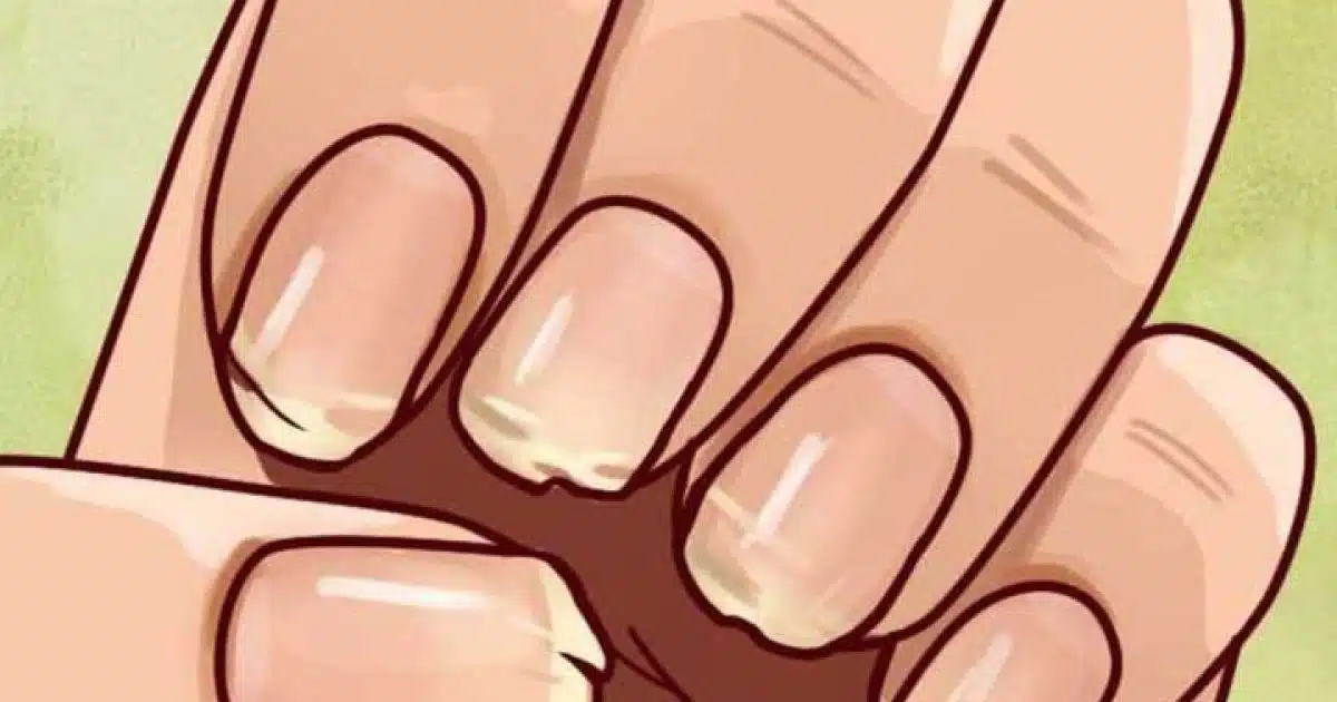 Ongles cassants ou dédoublés ? Ce que votre corps essaie peut-être de vous dire