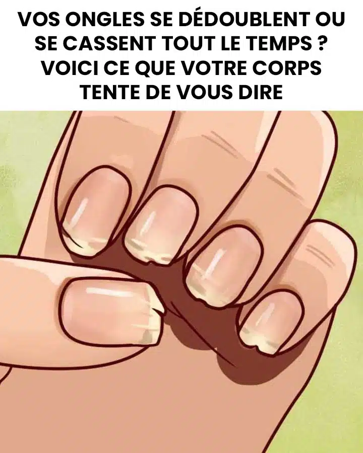 Ongles cassants ou dédoublés ? Ce que votre corps essaie peut-être de vous dire