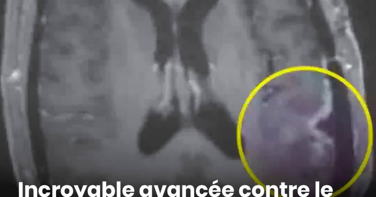 Percée contre le cancer : la tumeur cérébrale d'une femme a presque disparu en seulement cinq jours