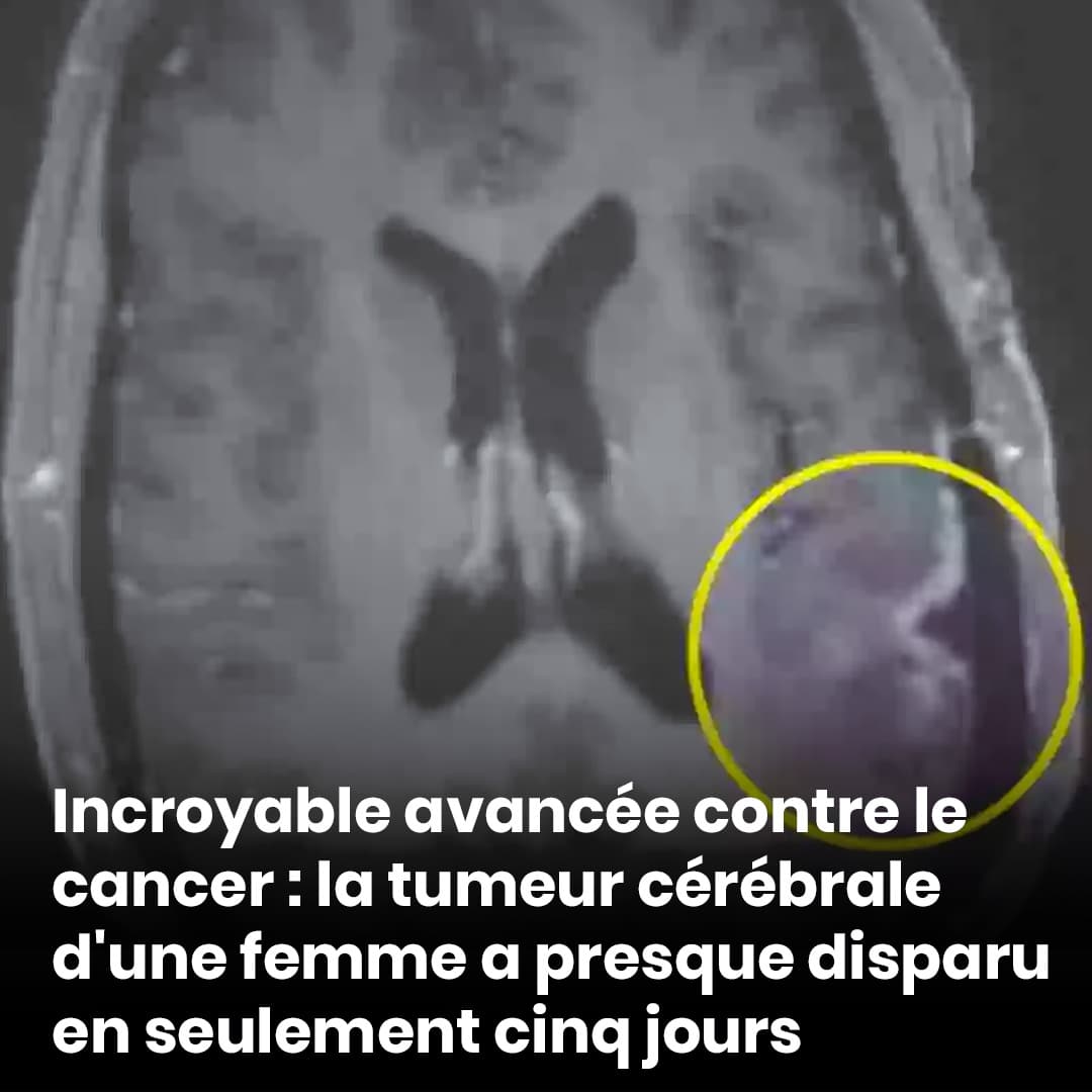 Percée contre le cancer : la tumeur cérébrale d'une femme a presque disparu en seulement cinq jours