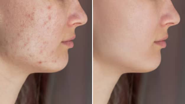 Comparaison avant/après traitement naturel pour les imperfections cutanées