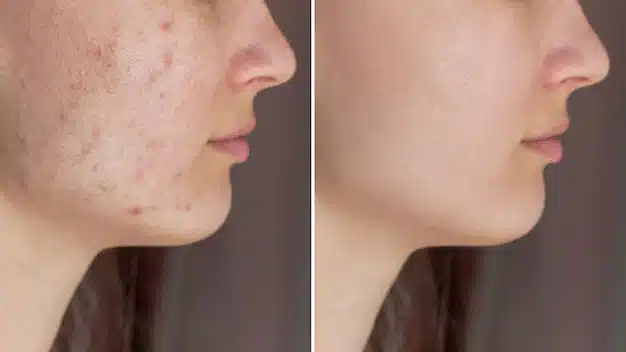 Comparaison avant/après traitement naturel pour les imperfections cutanées