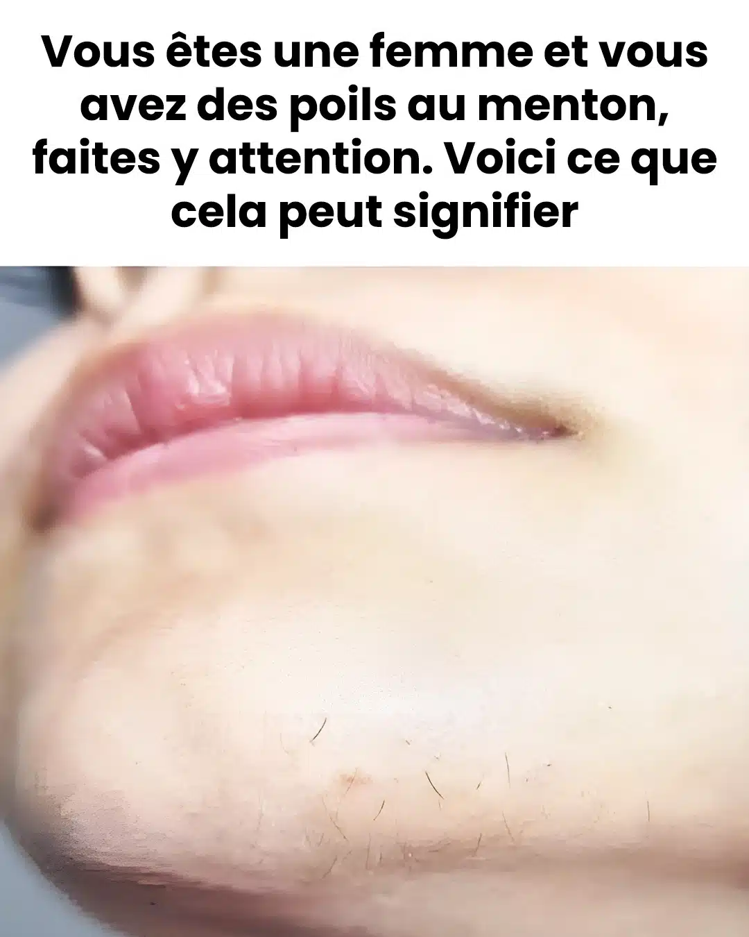 Poils au menton chez une femme : quelles significations ?