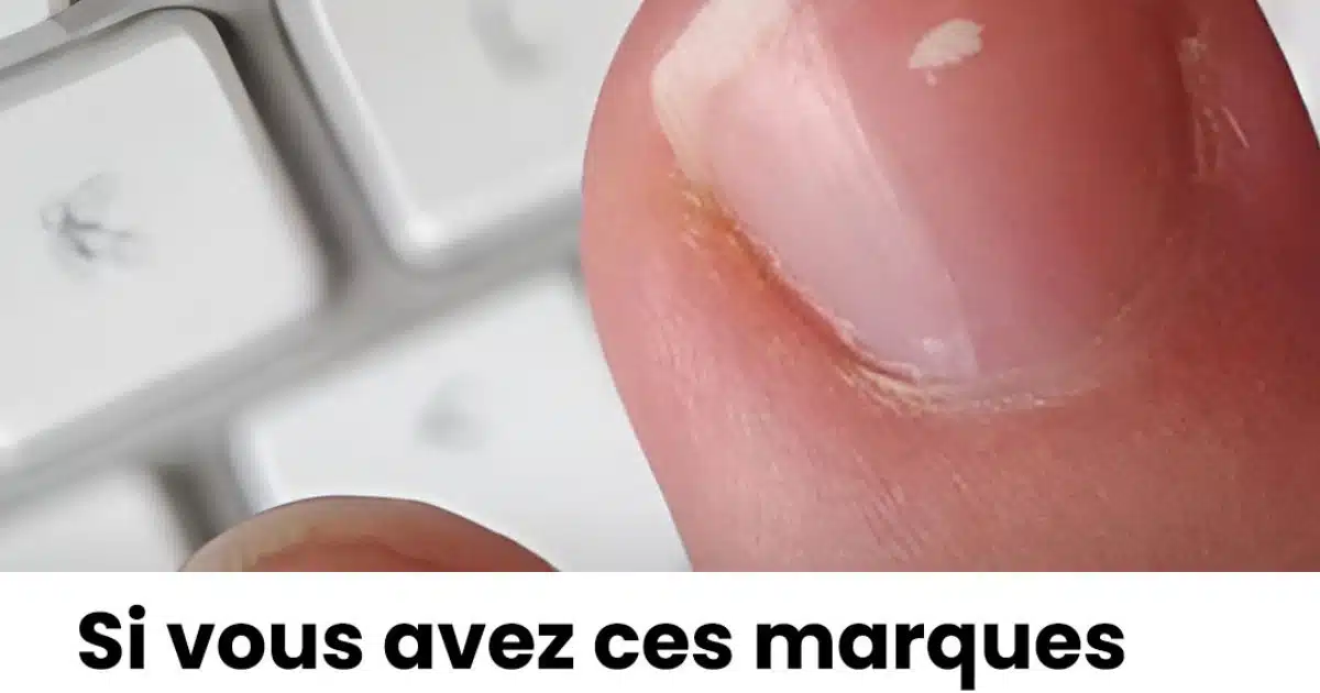 Pourquoi a-t-on des marques blanches sur les ongles ?