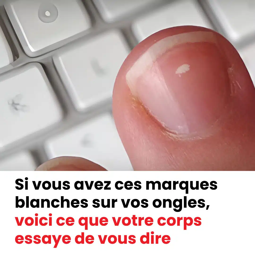 Pourquoi a-t-on des marques blanches sur les ongles ?