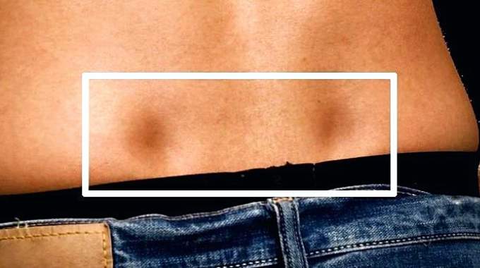 Représentation artistique historique mettant en lumière les fossettes lombaires