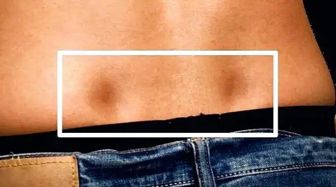 Représentation artistique historique mettant en lumière les fossettes lombaires