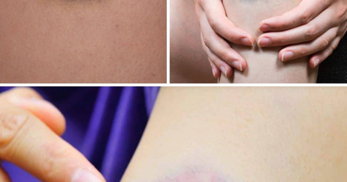 Pourquoi les bleus apparaissent sur la peau ?