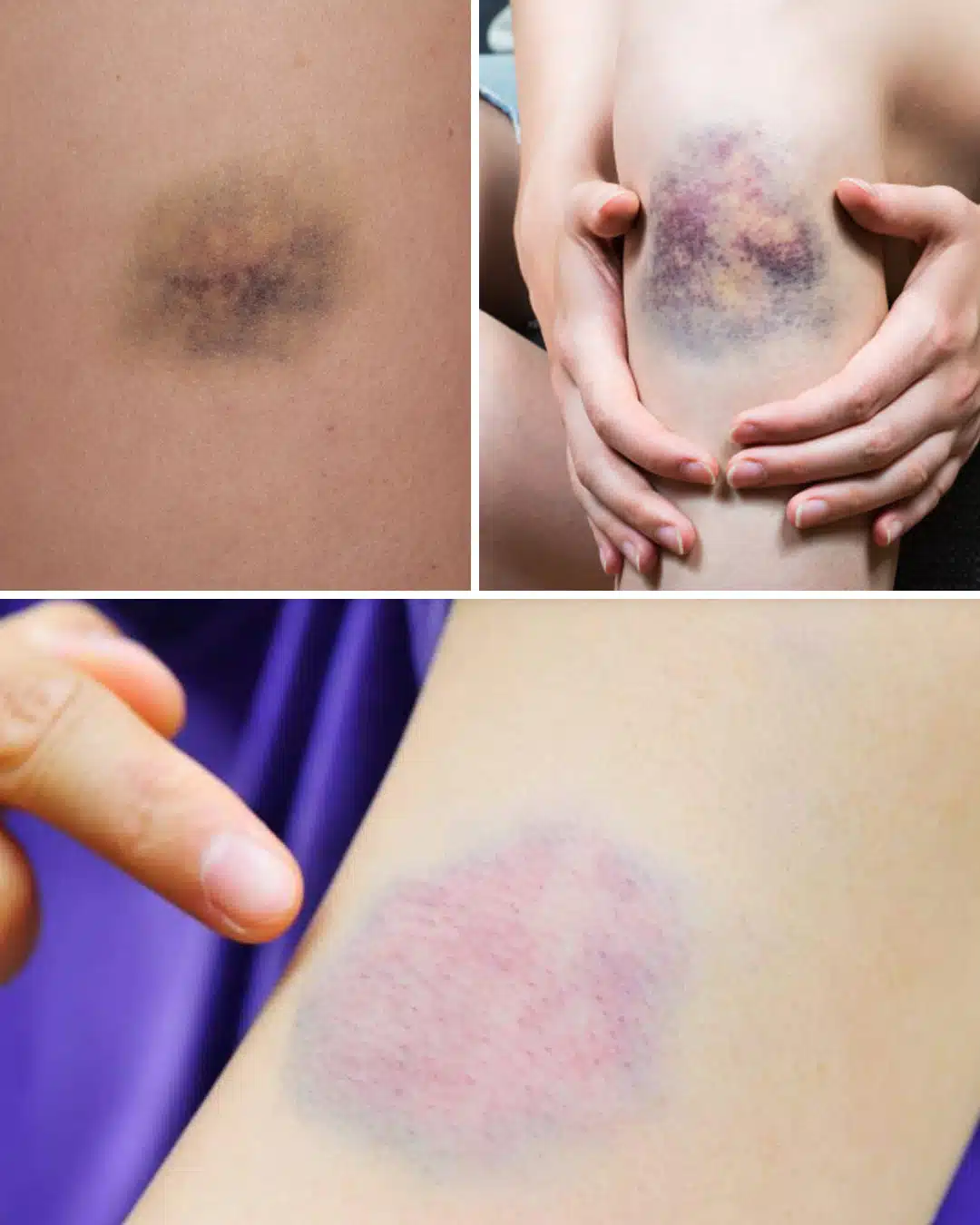 Pourquoi les bleus apparaissent sur la peau ?