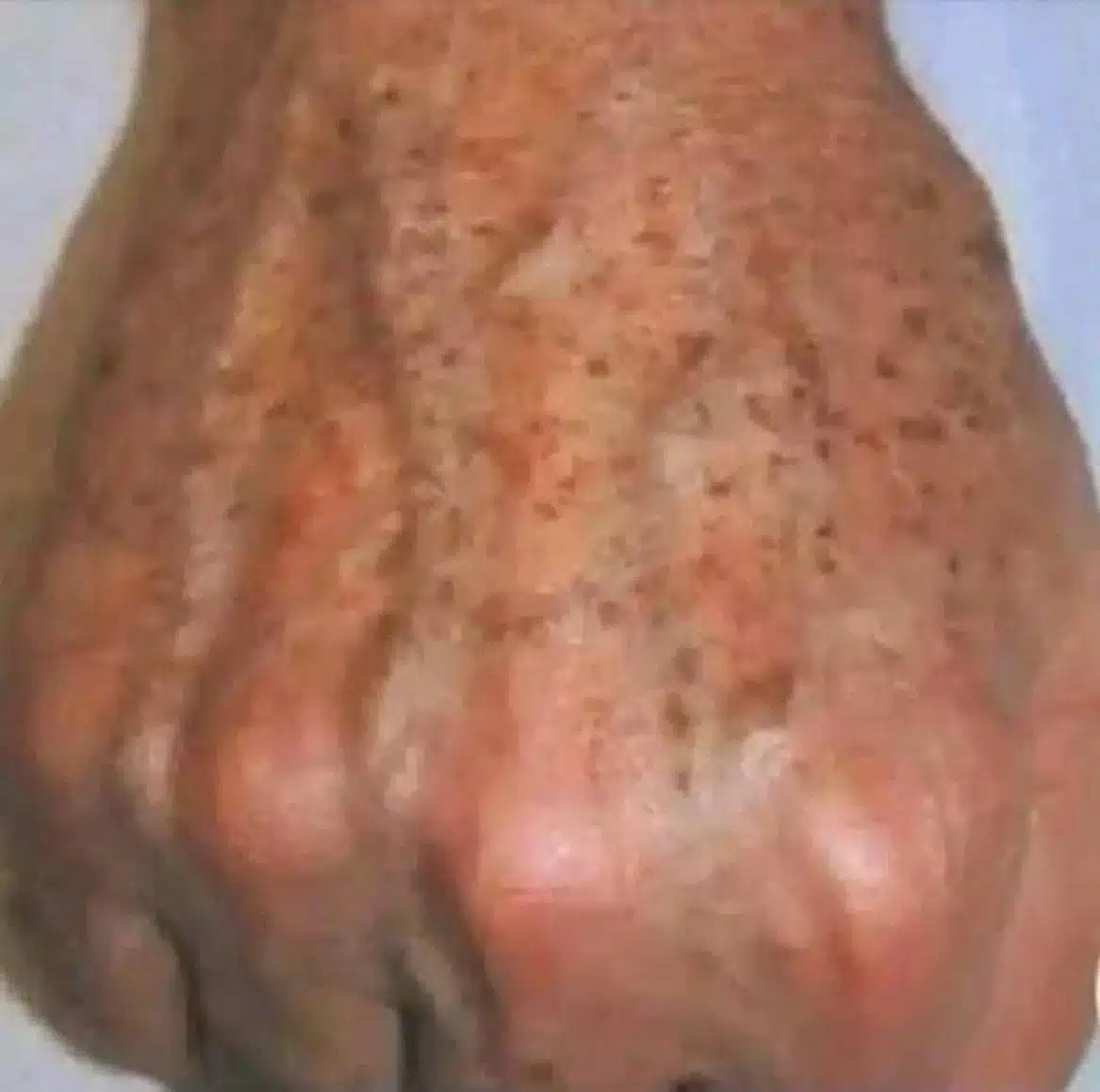 Pourquoi les taches apparaissent sur les mains et comment les éliminer ?