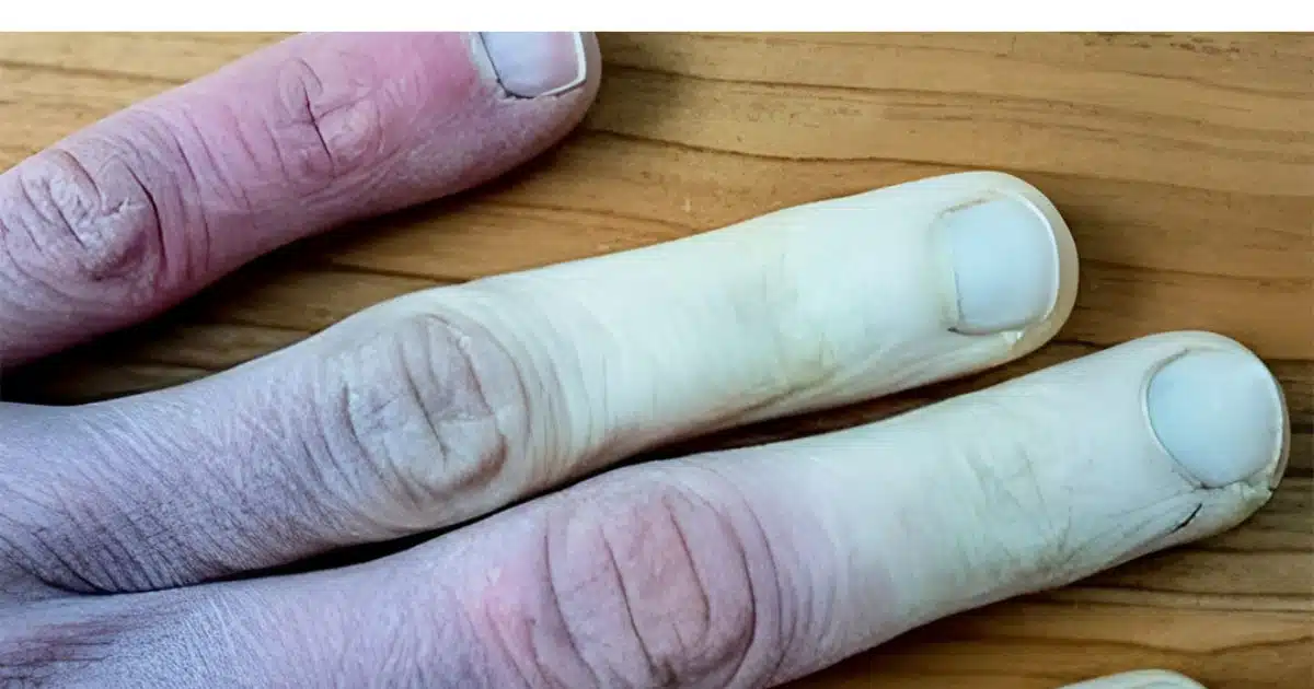 Que faire si vos doigts deviennent blancs en hiver ?