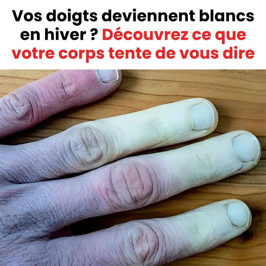 Que faire si vos doigts deviennent blancs en hiver ?