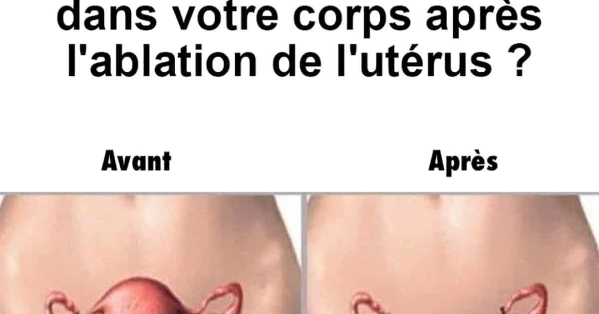 Que se passe-t-il dans le corps d’une femme lorsqu’on lui enlève l’utérus ?