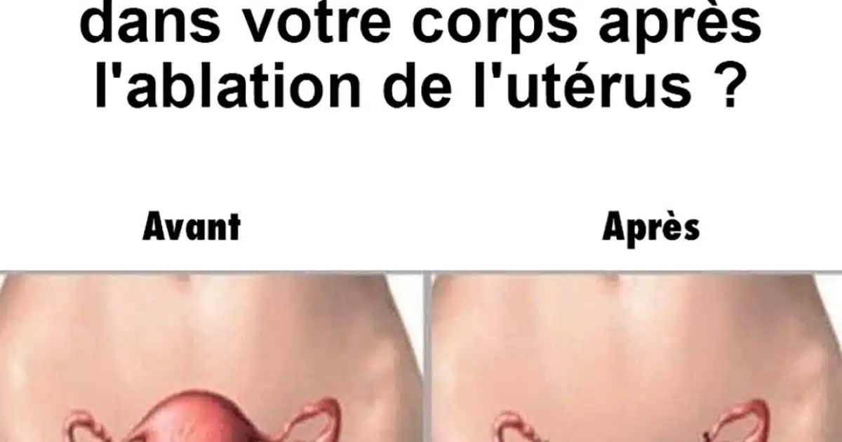 Que se passe-t-il dans le corps d’une femme lorsqu’on lui enlève l’utérus ?