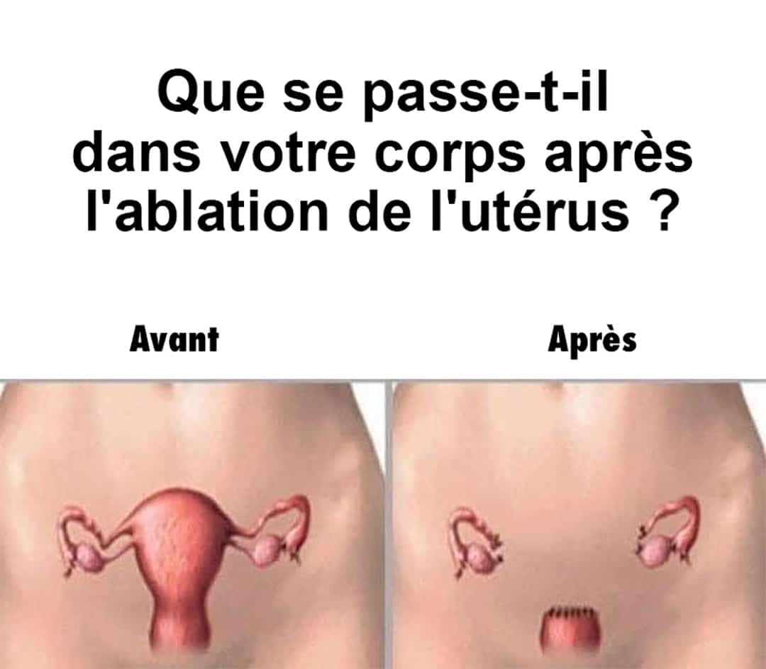 Que se passe-t-il dans le corps d’une femme lorsqu’on lui enlève l’utérus ?