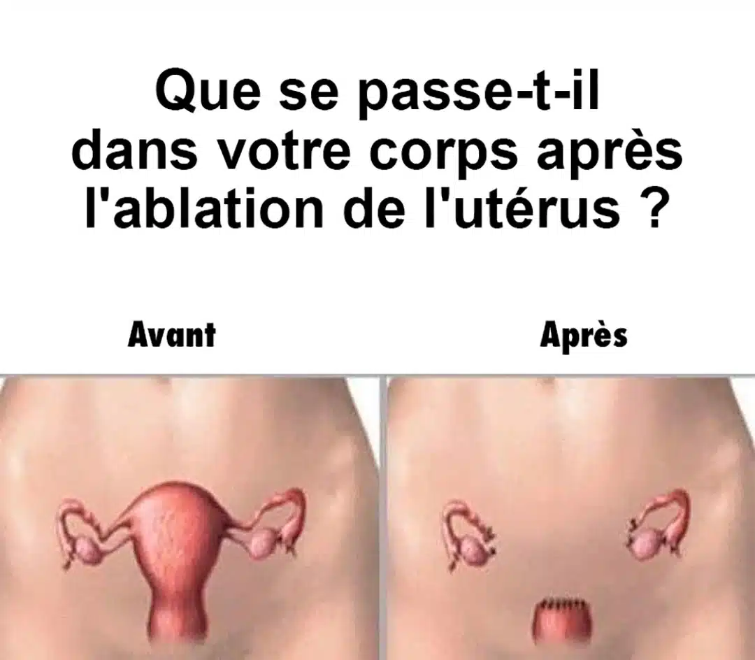 Que se passe-t-il dans le corps d’une femme lorsqu’on lui enlève l’utérus ?