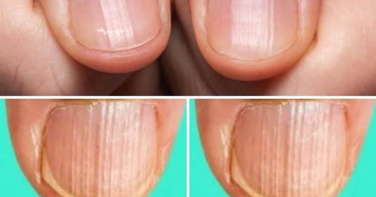 Que signifie avoir les ongles rayés ?
