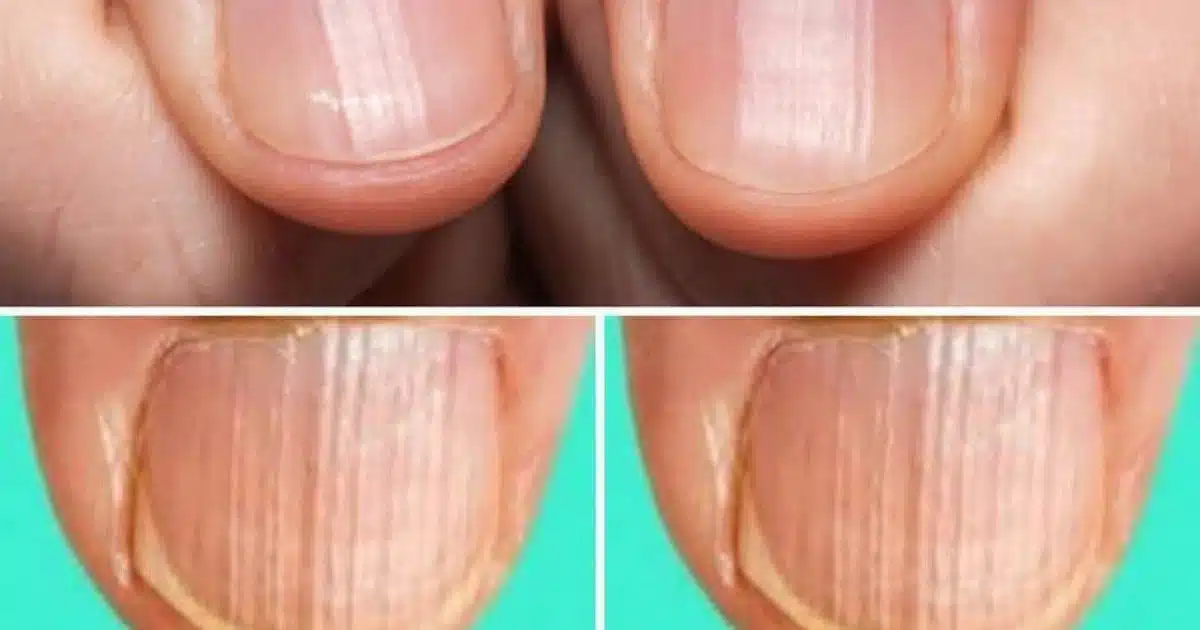 Que signifie avoir les ongles rayés ?