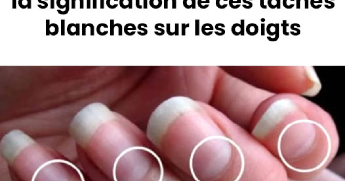 Que signifie les taches blanches sur les ongles ?