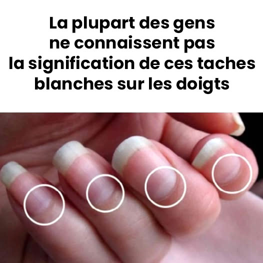 Que signifie les taches blanches sur les ongles ?