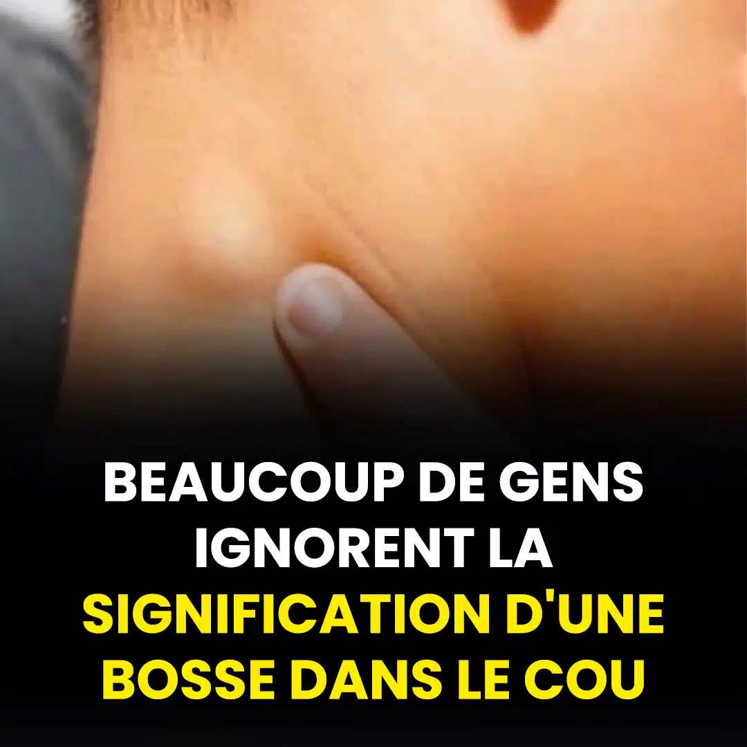 Que signifie une bosse dans le cou ?