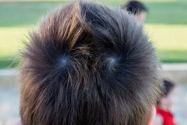 Que signifient des cheveux à double couronne sur la tête d’une personne ?