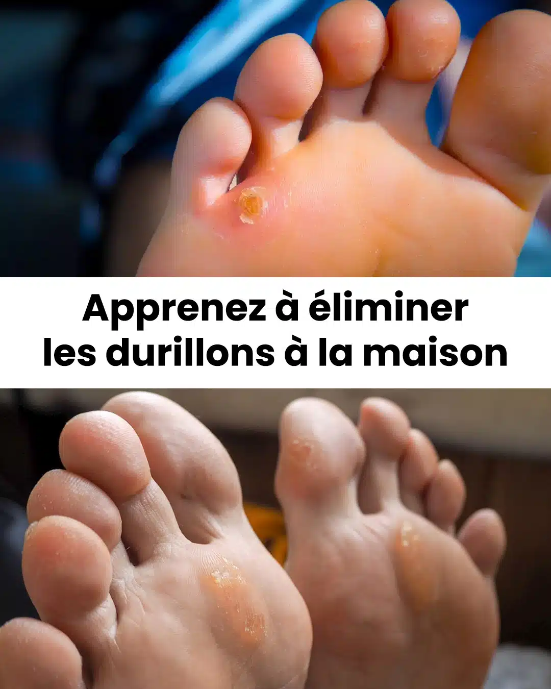 Quelles sont les méthodes pour éliminer les durillons ?