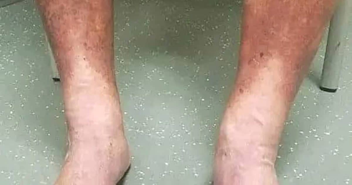 Quels sont les premiers symptômes de la maladie de Charcot ?