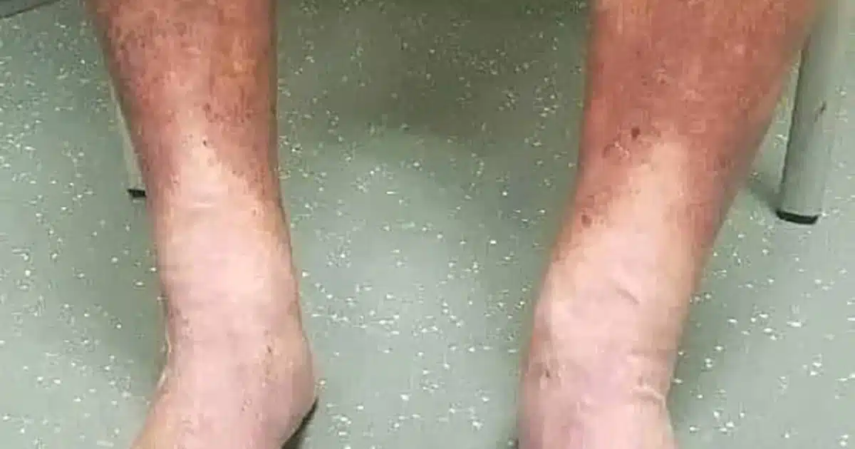 Quels sont les premiers symptômes de la maladie de Charcot ?