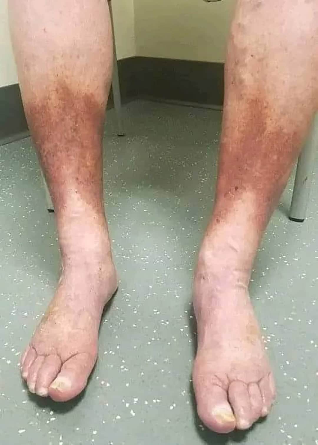Quels sont les premiers symptômes de la maladie de Charcot ?