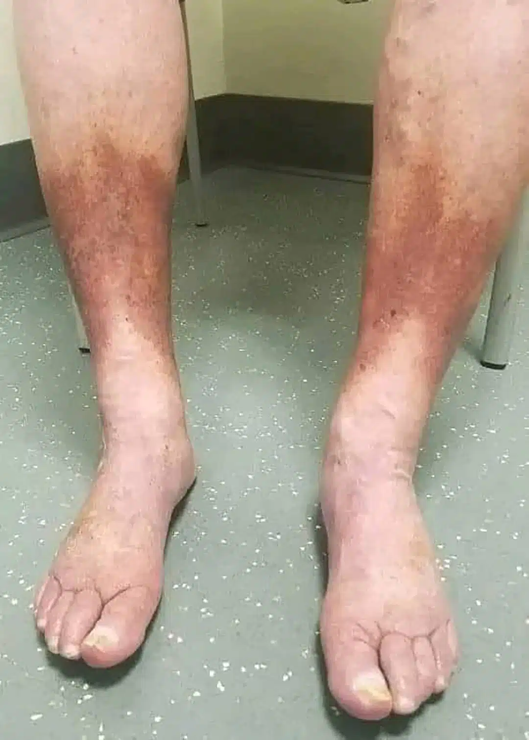 Quels sont les premiers symptômes de la maladie de Charcot ?