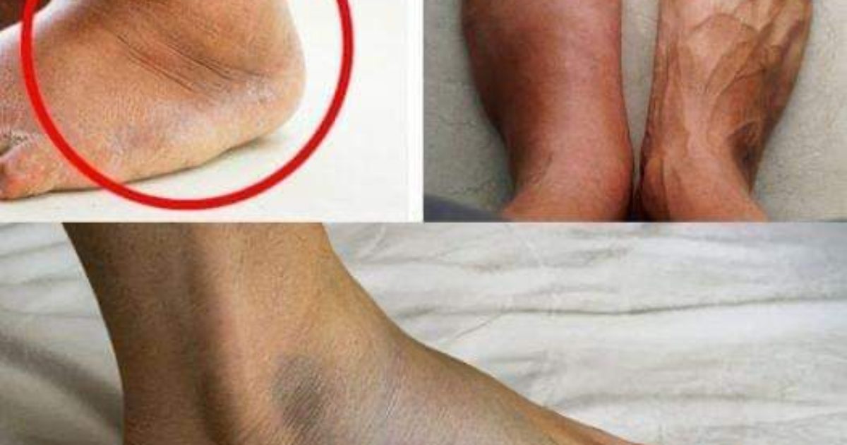 Quels sont les symptômes de l'infarctus chez la femme ?